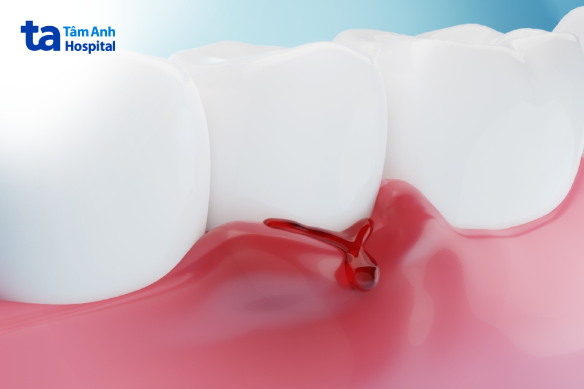 Triệu chứng sưng nướu răng là gì?