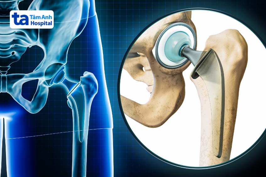 Khi bị khô khớp nặng, người bệnh có thể cần phẫu thuật để điều trị