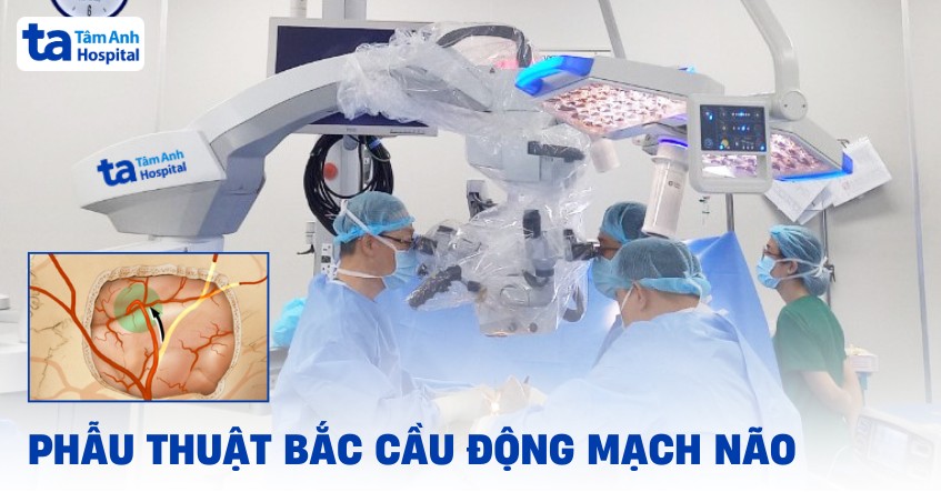 Phẫu thuật bắc cầu động mạch não: Quy trình, chỉ định và rủi ro