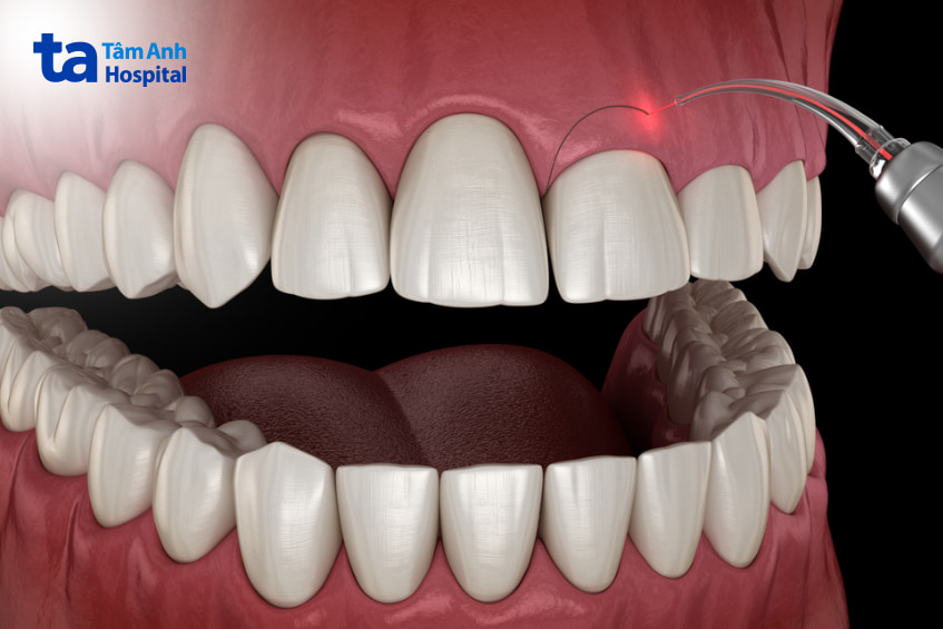 Các phương pháp phẫu thuật cắt lợi, laser