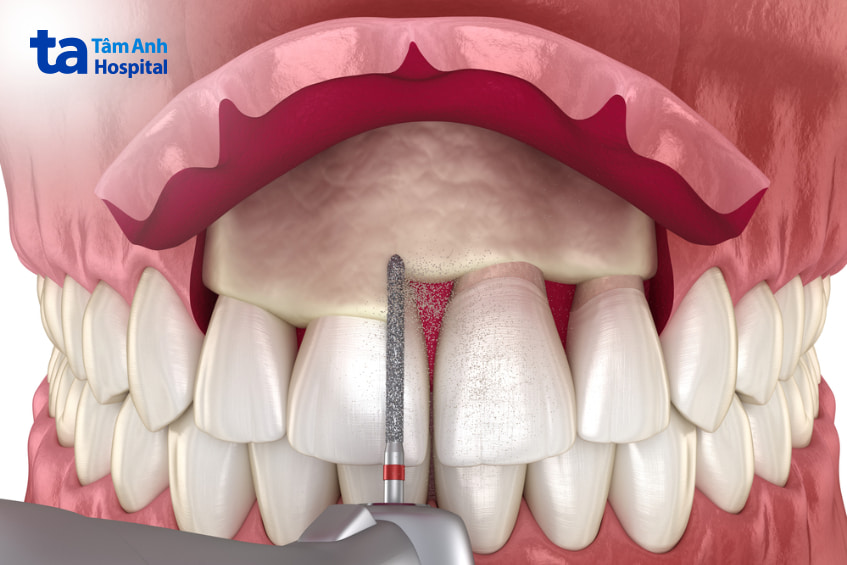 Cắt lợi làm dài thân răng chữa cười hở lợi