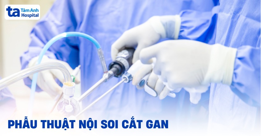 Phẫu thuật nội soi cắt gan: Quy trình thực hiện và các thắc mắc