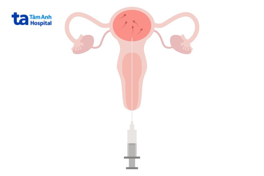 Phương pháp bơm tinh trùng vào buồng tử cung (IUI)