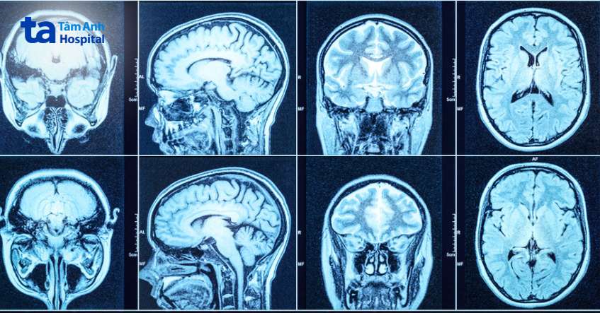 phương pháp chẩn đoán hội chứng bàng quang thần kinh