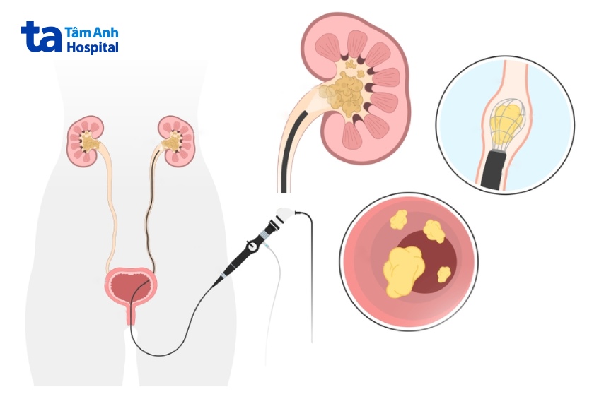 quy trình tán sỏi ngược dòng bằng ống mềm