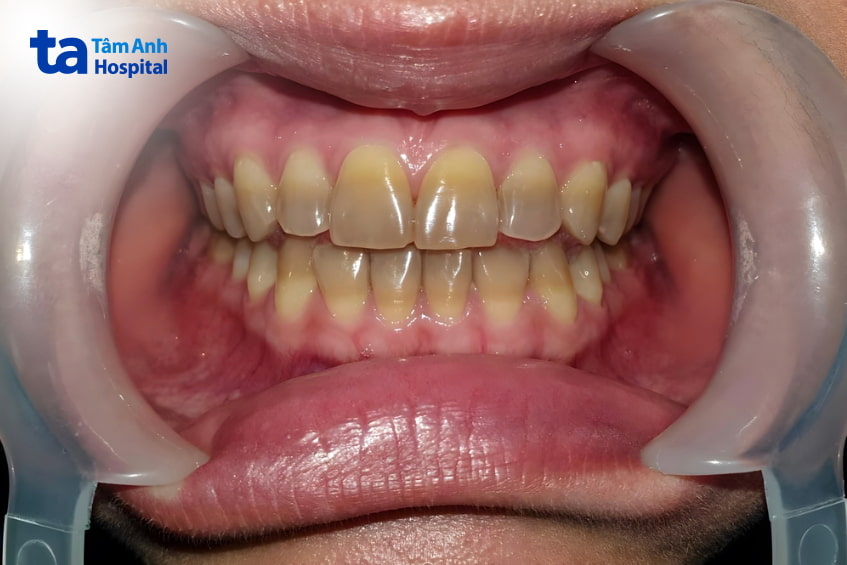 Răng đổi màu do nhiễm kháng sinh tetracycline