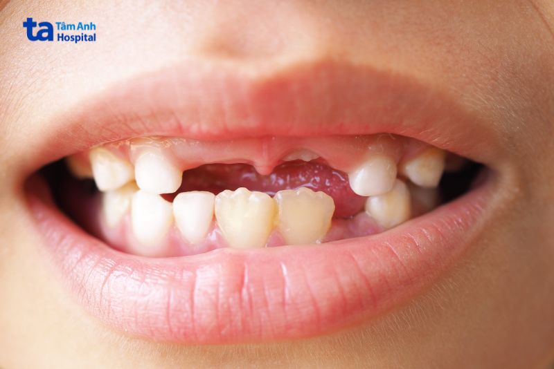 Nguyên nhân và các yếu tố gây ra tình trạng răng mọc lẫy ở trẻ em