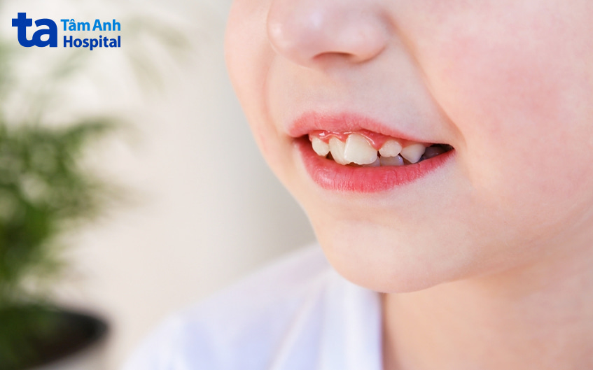 Dấu hiệu răng mọc lệch, răng lệch hàm