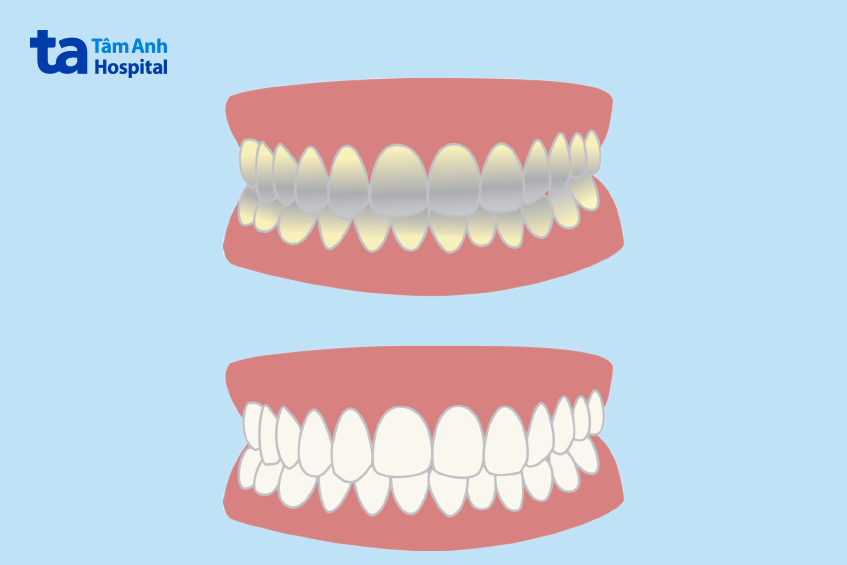 Triệu chứng răng bị nhiễm tetracycline
