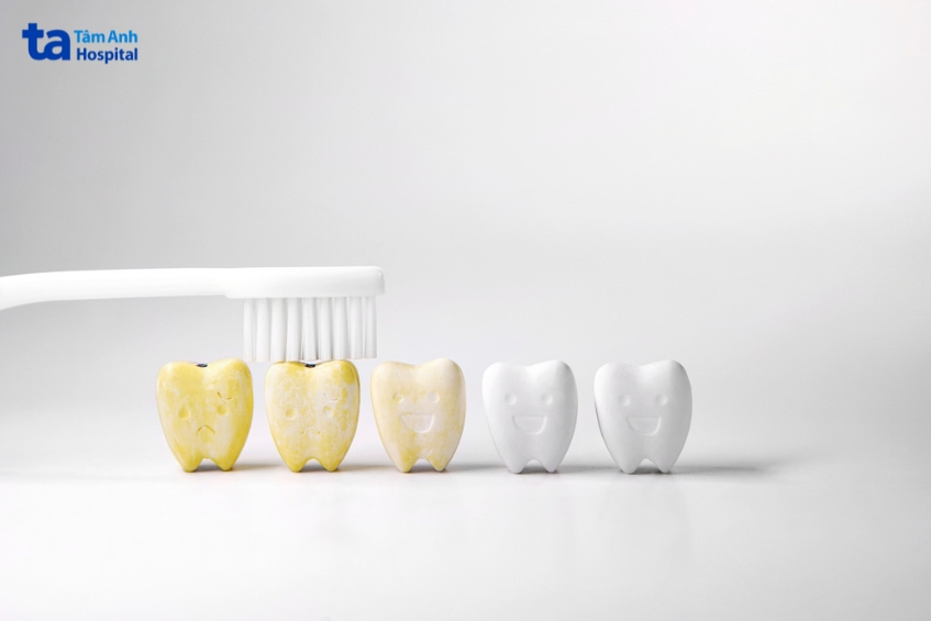 Răng ố vàng là gì?