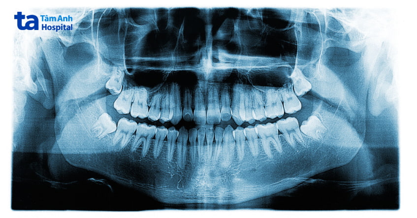 biến chứng của viêm lợi trùm răng khôn, ảnh hưởng đến các răng bên cạnh