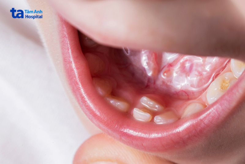 Răng mọc lẫy vào trong ở trẻ em