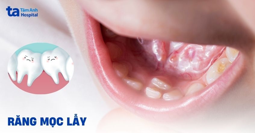 Răng mọc lẫy ở trẻ: Dấu hiệu, ảnh hưởng, cách xử lý và phòng ngừa