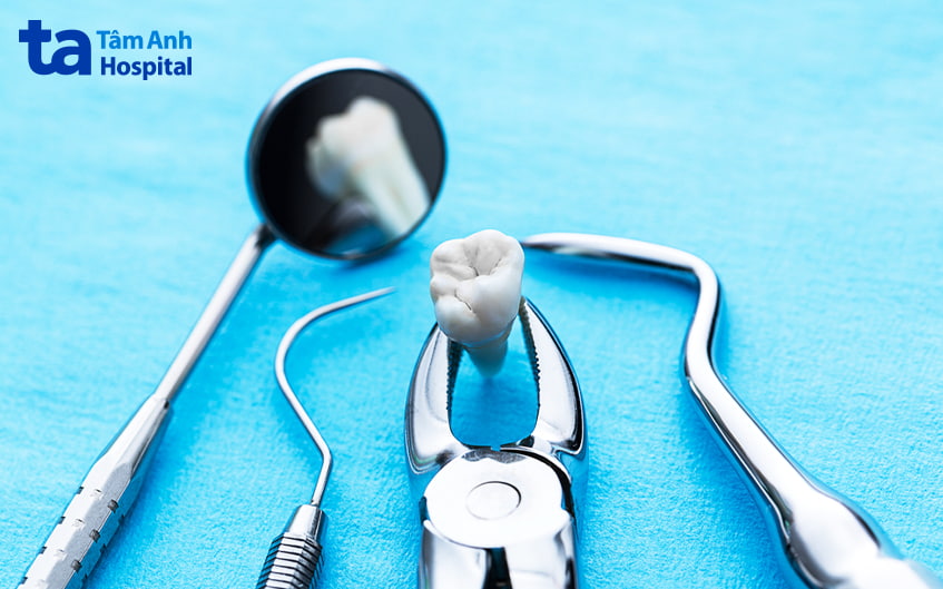 răng khôn mọc lệch cần được nhổ bỏ