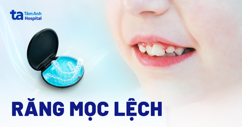 Răng mọc lệch: Nguyên nhân, dấu hiệu, hệ quả và cách xử lý