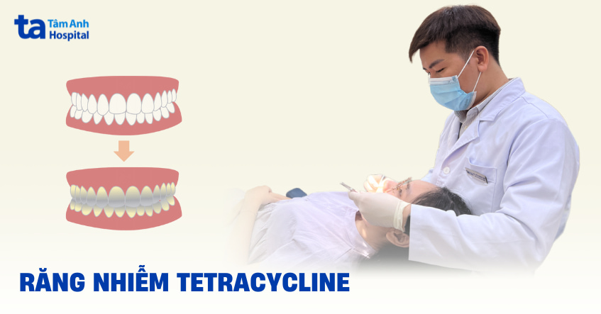 răng nhiễm tetracycline