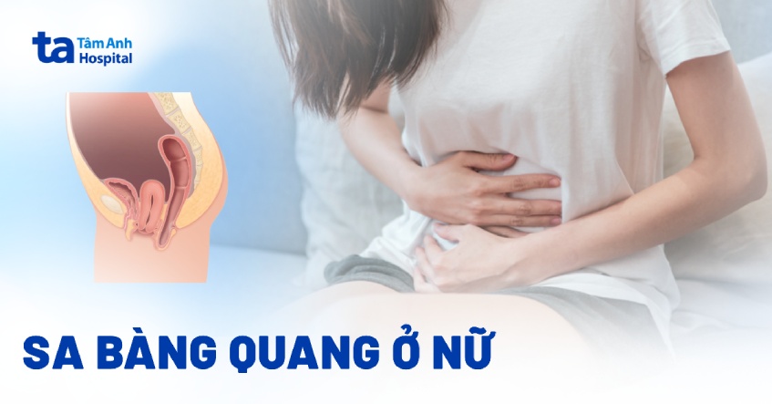 Sa bàng quang ở nữ: Nguyên nhân, triệu chứng, và cách điều trị