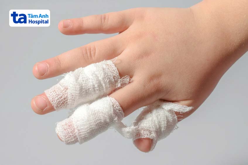 Sau khi phẫu thuật tách dính ngón tay