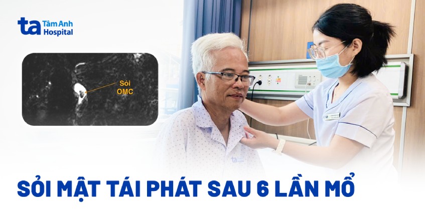 sỏi mật tái phát sau 6 lần mổ