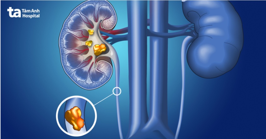 sỏi niệu quản 1 3 trên là gì