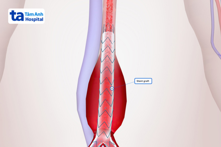 Stent graft có tác dụng trong việc điều trị phình động mạch chủ