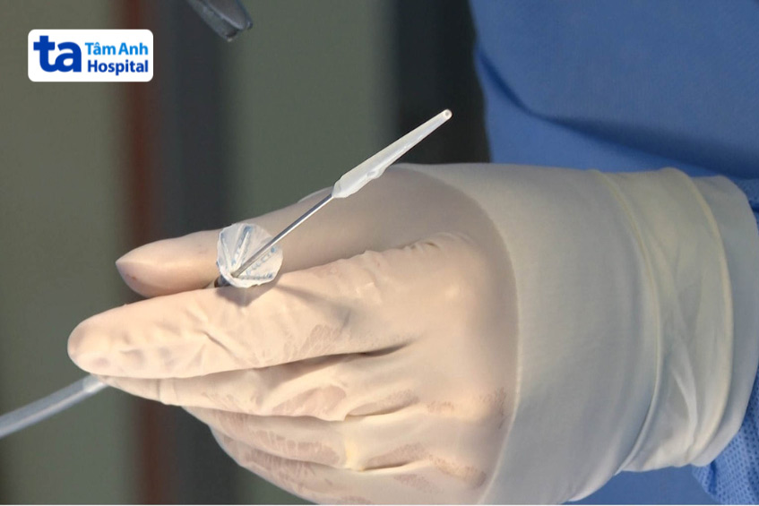 Stent graft là một cuộn dây kim loại nhỏ hoặc ống lưới