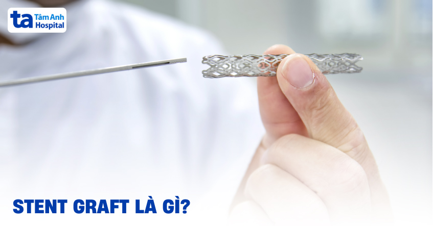 Stent graft là gì? Vai trò, cấu tạo và chức năng hoạt động