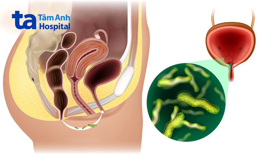 Sức chứa bàng quang yếu cũng là nguyên nhân gây nhiễm trùng tiết niệu