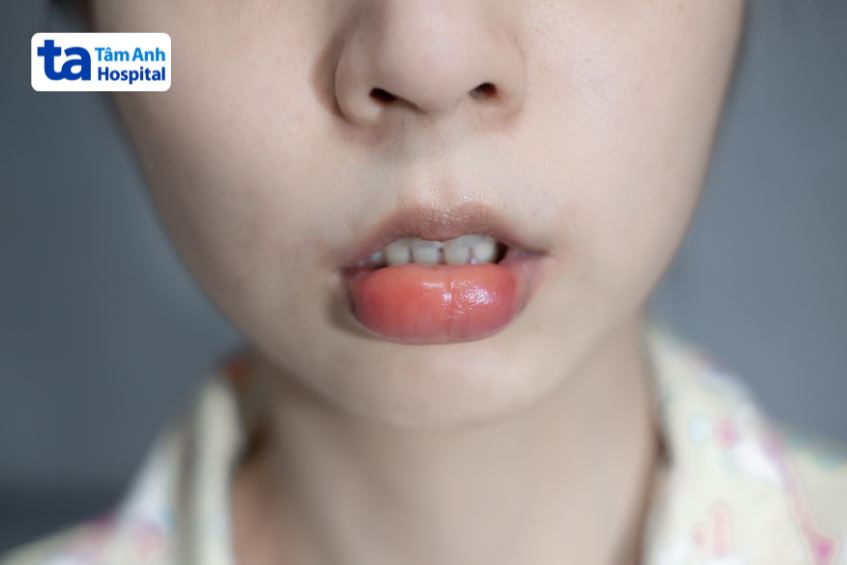 tác dụng phụ phù mạch ở miệng