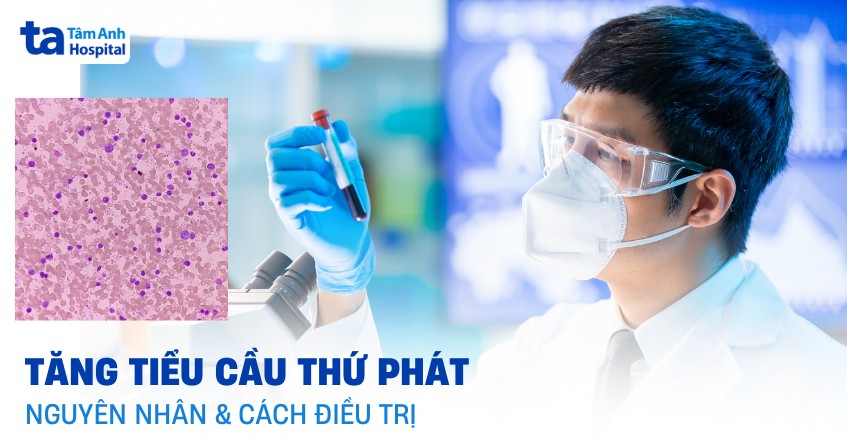 Tăng tiểu cầu thứ phát: Nguyên nhân, triệu chứng, và điều trị