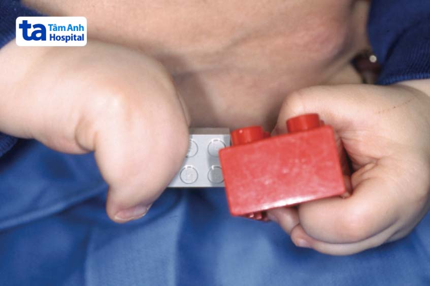 Tật dính ngón phức tạp