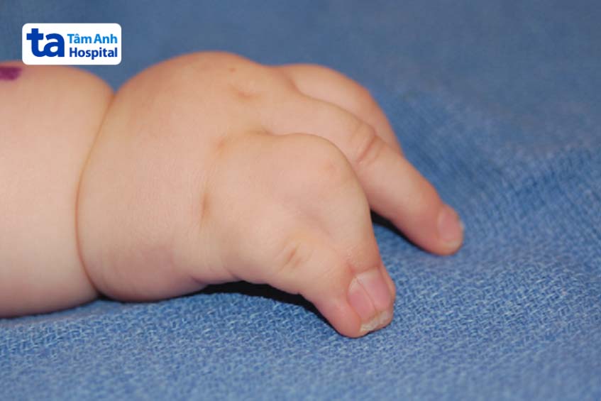 Tật dính ngón tay út và áp út