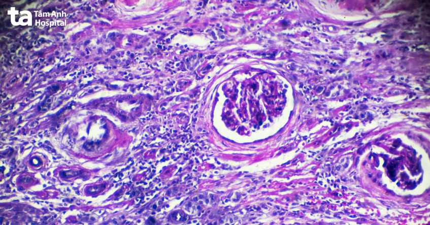 tế bào viêm cầu thận dưới kính hiển vi