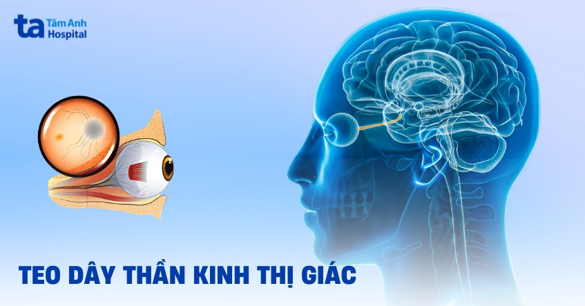 teo dây thần kinh thị giác