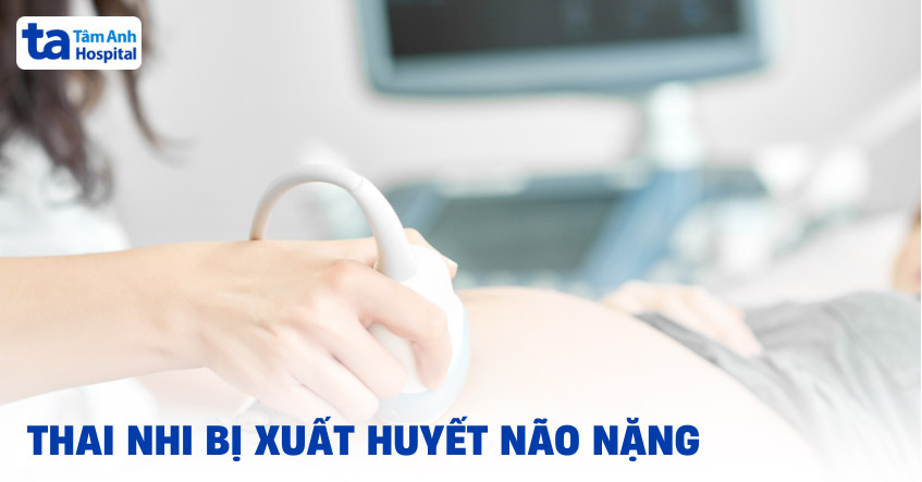 thai nhi bị xuất huyết não nặng