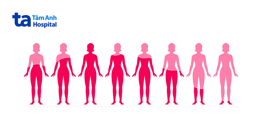 Suy giảm hormone nguyên nhân gây nhiễm khuẩn đường tiết niệu