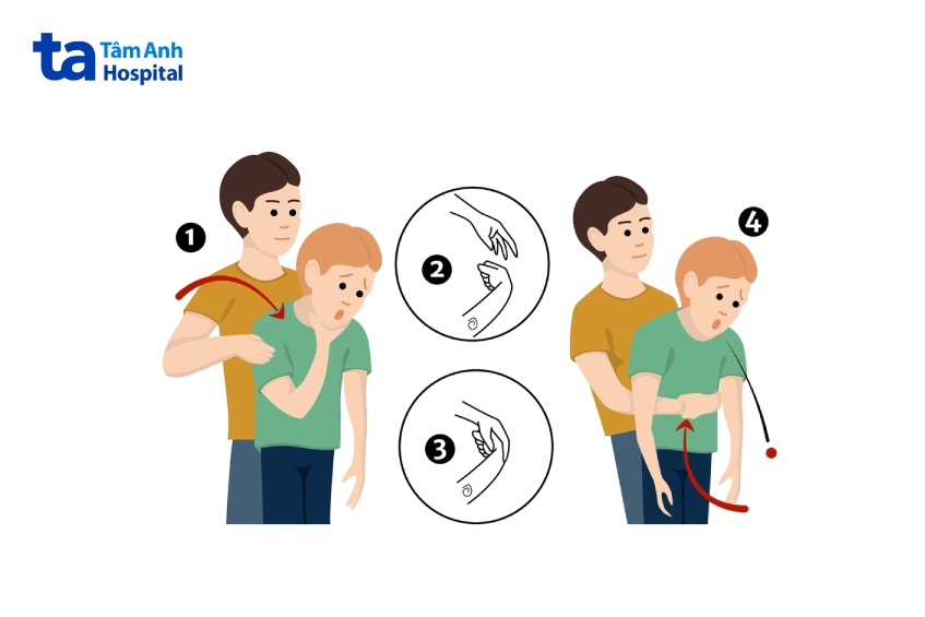 thủ thuật heimlich được áp dụng