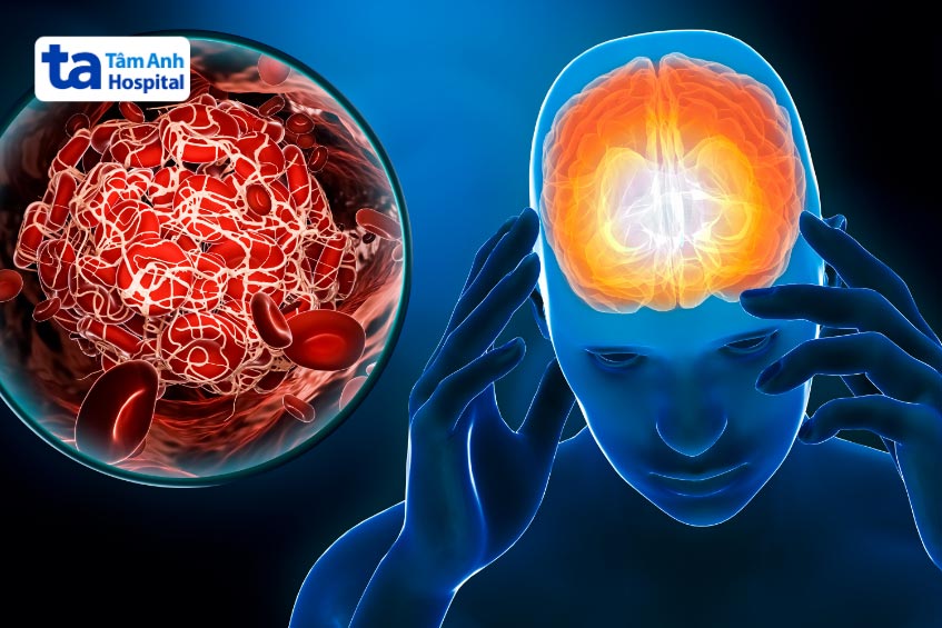 Thuốc kháng đông trong rung nhĩ nhằm giảm nguy cơ đột quỵ