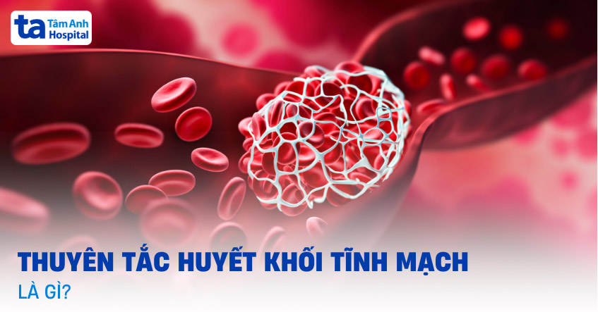 Thuyên tắc huyết khối tĩnh mạch: Nguyên nhân, dấu hiệu và điều trị
