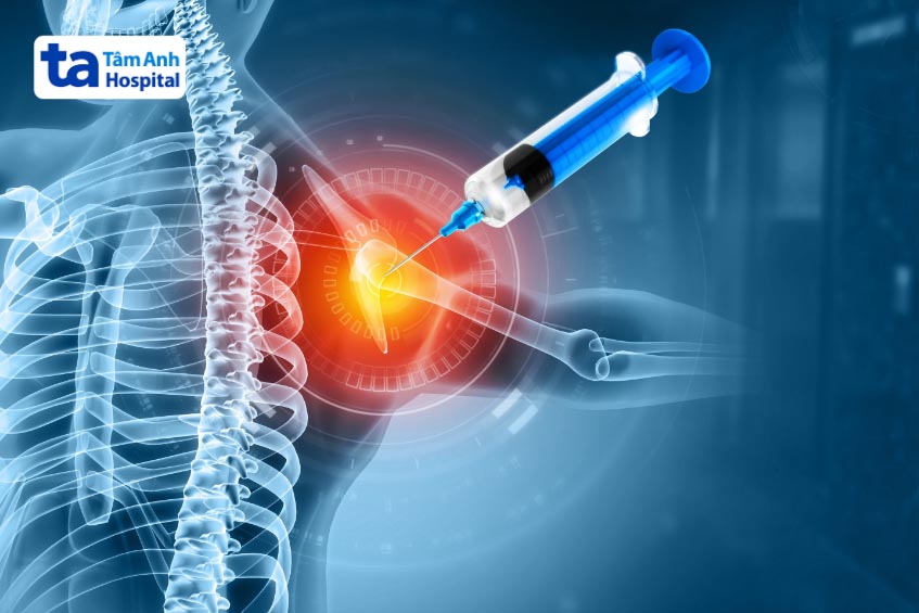 Tiêm chất nhờn hyaluronic acid hỗ trợ điều trị khô khớp vai