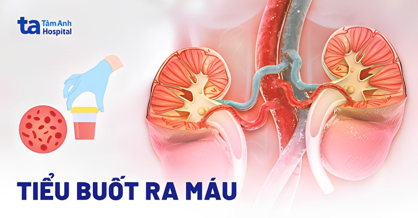 Tiểu buốt ra máu ở nam: Nguyên nhân, triệu chứng, cách điều trị