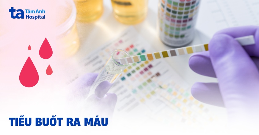 Đi tiểu buốt ra máu: Nguyên nhân, triệu chứng, điều trị, phòng ngừa