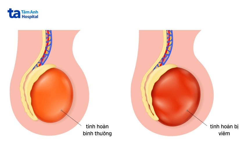 tinh hoàn bình thường và tinh hoàn bị viêm