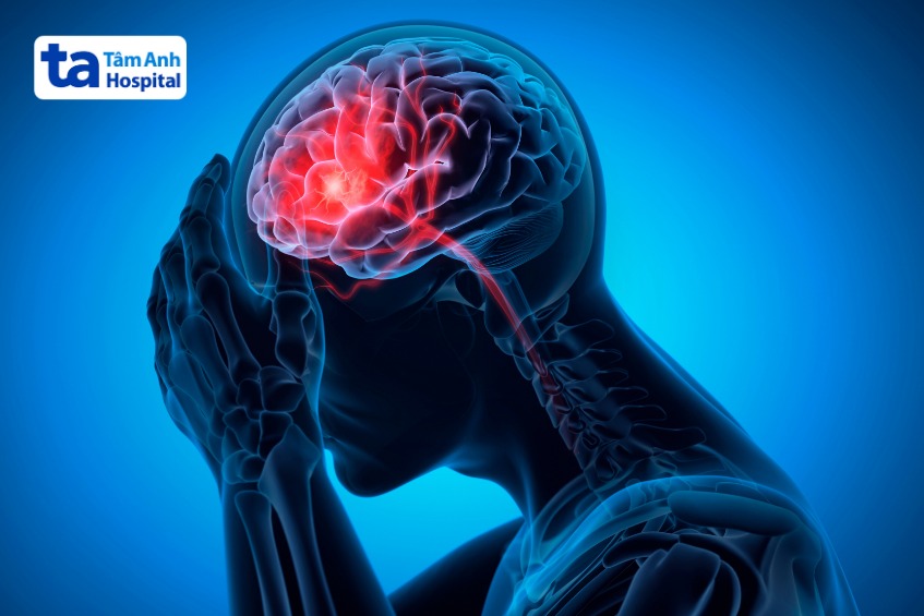 tình trạng chảy máu dưới khoang nhện nguy hiểm