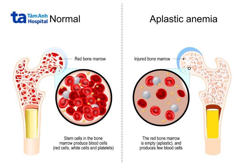 tình trạng suy tủy xương