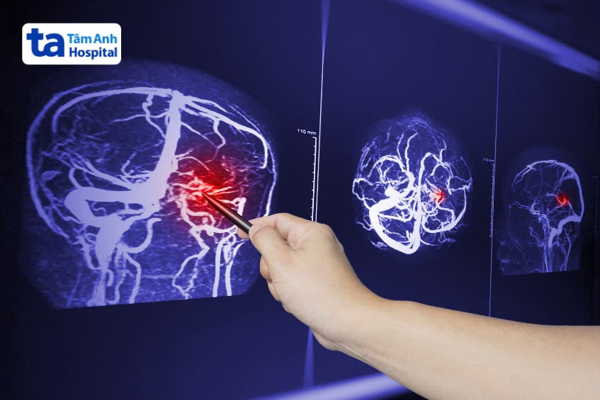 tình trạng xuất huyết não thất