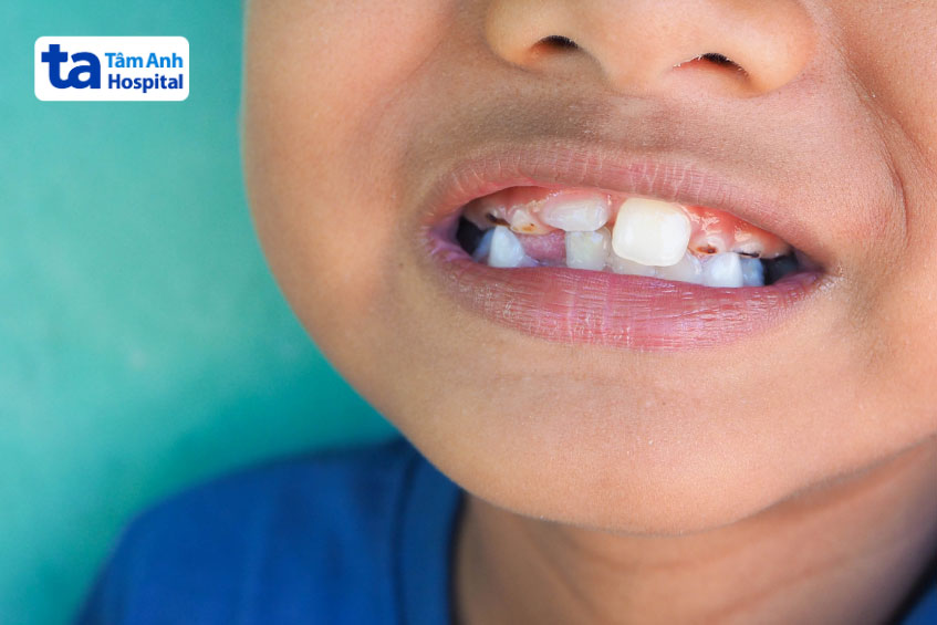 Trẻ bị mòn men răng do axit từ trào ngược dạ dày