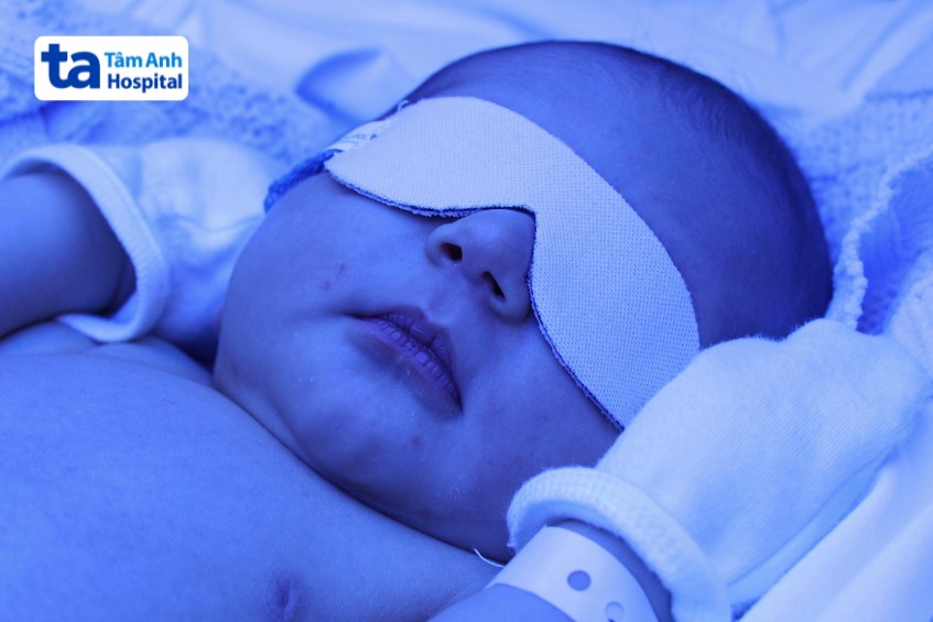 Trẻ được bịt mắt cẩn thận nhằm hạn chế tổn thương võng mạc 