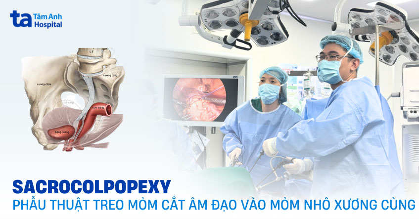 Phẫu thuật treo mỏm cắt âm đạo vào mỏm nhô xương cùng (Sacrocolpopexy)