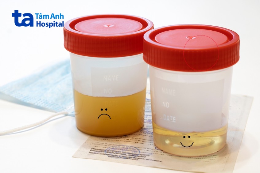 triệu chứng tiểu buốt ra máu ở nam giới